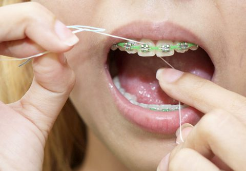 Niềng răng thẩm mỹ – Các phương pháp và cách chăm sóc khi niềng